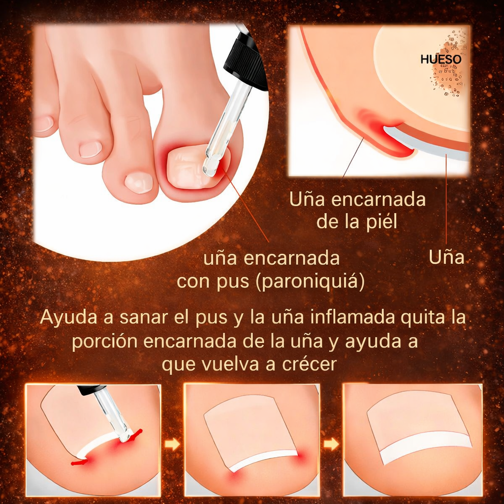 OIL RELIEF - Tratamiento que elimina el hongo de tus Uñas 100% Efectivo