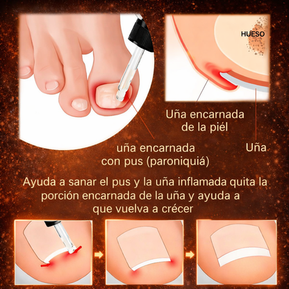 OIL RELIEF - Tratamiento que elimina el hongo de tus Uñas 100% Efectivo